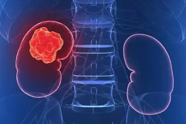 best doctor for kidney cancer surgery in india, best hospital for kidney cancer surgery in india, cost of kidney cancer treatment in india, dr pradeep bansal best cancer surgeon in india, best treatment for kidney cancer in india