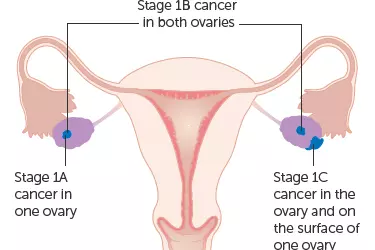 best doctor for ovarian cancer treatment in india, best hospital for ovarian cancer treatment in india, cost of ovarian cancer treatment in india, dr rama joshi, dr amita shah best gynec cancer surgeon in india